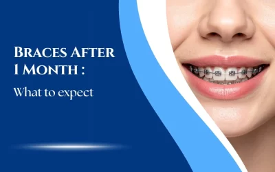Braces After 1 Month: What to Expect