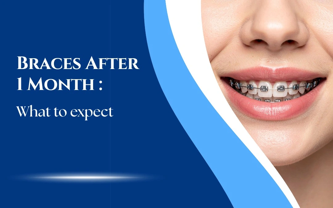 Braces After 1 Month: What to Expect